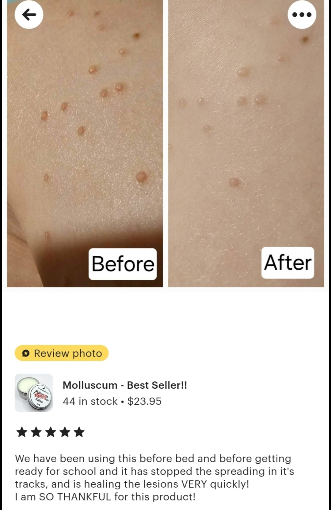 Molluscum Contagiosum Salve