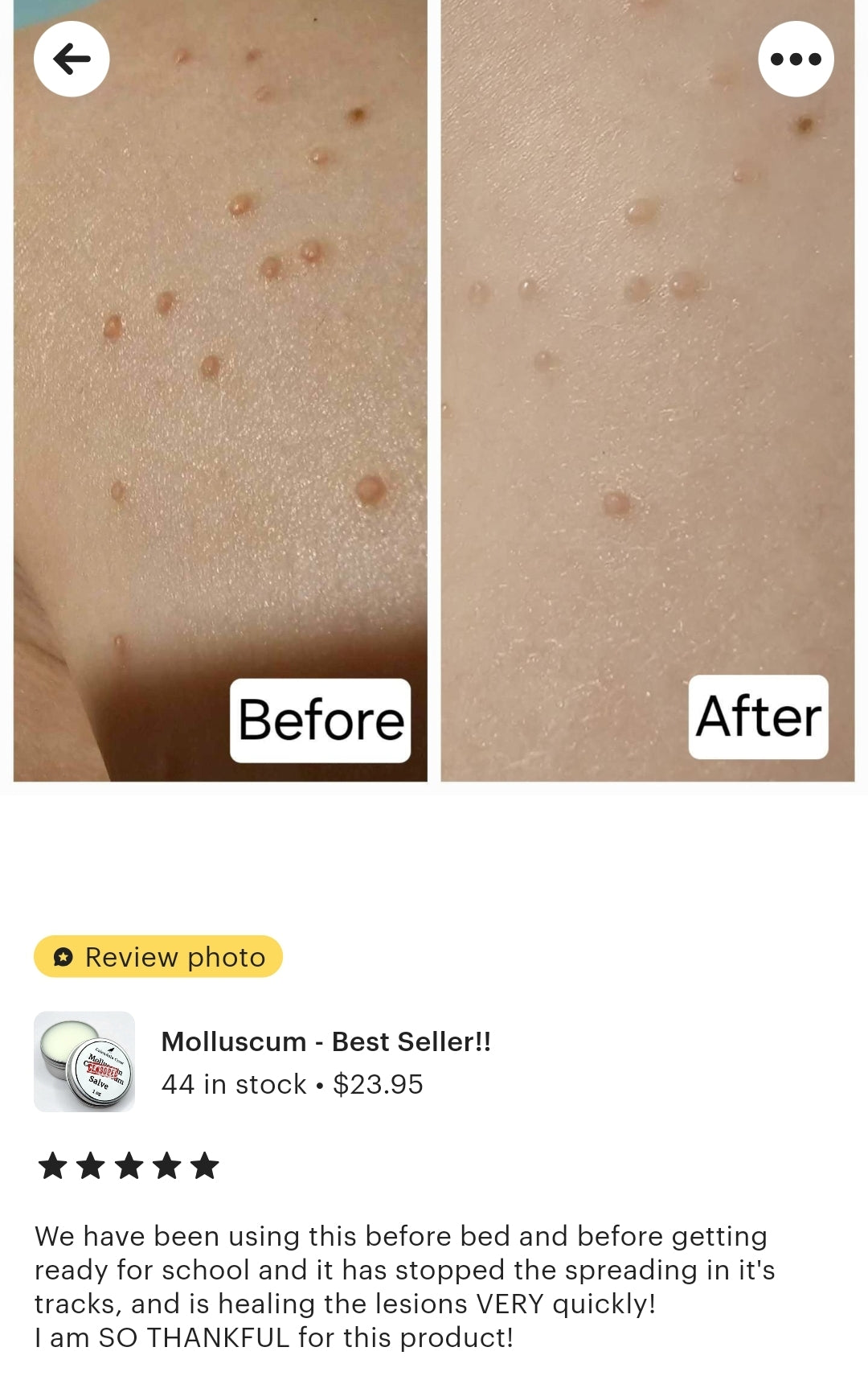 Molluscum Contagiosum Salve